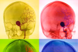 Các phương pháp chẩn đoán mạch máu não