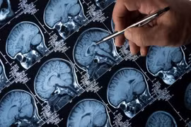 Sán dây sống 20 năm trong não?