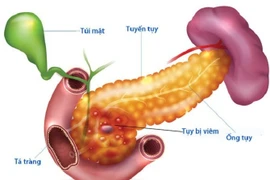 70% viêm tụy liên quan đến rượu bia