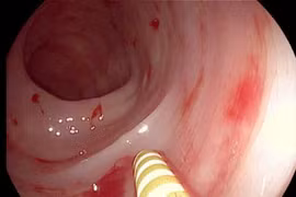 Chảy máu dạ dày vì quá lo lắng con thi