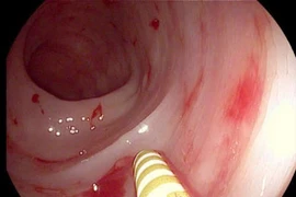 Chảy máu dạ dày vì quá lo lắng con thi