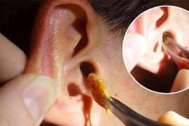 Nhức đầu, ù tai vì nút ráy