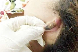 Hoại tử mũi, nát ngực vì làm đẹp đón Tết