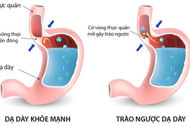 Xạ hình chẩn đoán trào ngược dạ dày-thực quản