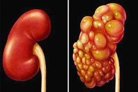 Dấu hiệu ung thư thận