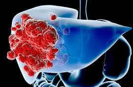Tắc mạch hóa dầu điều trị ung thư gan