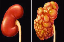 Dấu hiệu ung thư thận