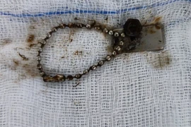  Trẻ thủng ruột vì nuốt nam châm 