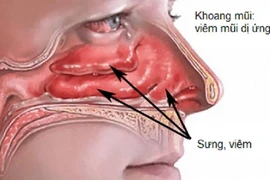 Kích thích huyệt tay điều trị viêm mũi dị ứng