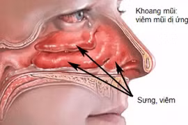 Kích thích huyệt tay điều trị viêm mũi dị ứng