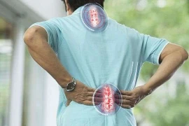 Cắt bảng sống trong vôi hóa cột sống