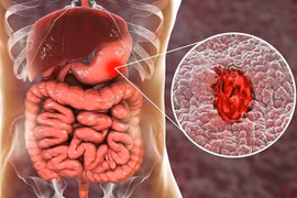 Chảy máu dạ dày vì ăn vặt