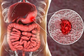 Chảy máu dạ dày vì ăn vặt