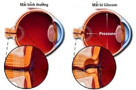 Cẩn thận mù khi thấy mắt mờ 