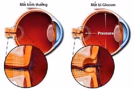 Cẩn thận mù khi thấy mắt mờ 
