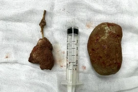 Cấp cứu vì sỏi khổng lồ bám quanh ông thông niệu quản bỏ quên 5 năm