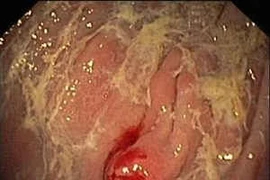 Tiêu chảy cẩn thận ung thư carcinoid đặc biệt nguy hiểm