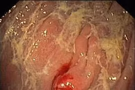 Tiêu chảy cẩn thận ung thư carcinoid đặc biệt nguy hiểm