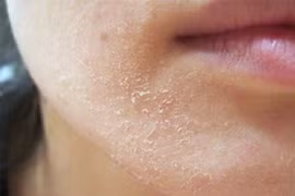 Trời lạnh da khô mốc, nứt nẻ