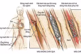Can thiệp động mạch vành