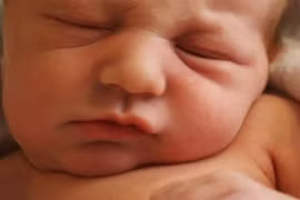 Phục hồi chức năng cho trẻ bị vẹo cổ bẩm sinh