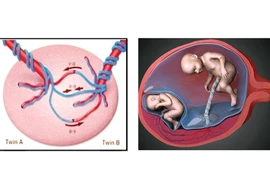 Phẫu thuật điều trị hội chứng truyền máu song thai