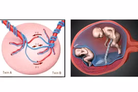 Phẫu thuật điều trị hội chứng truyền máu song thai