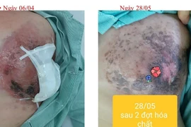 Ung thư vú di căn vì đắp thuốc Nam