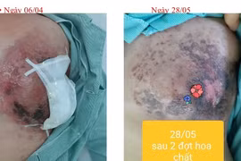 Ung thư vú di căn vì đắp thuốc Nam