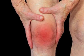 Nên xét nghiệm axit uric định kỳ để tránh gút cấp