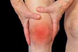 Nên xét nghiệm axit uric định kỳ để tránh gút cấp