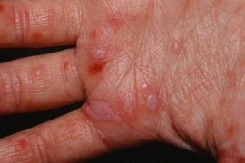 Người trưởng thành vẫn có thể mắc bệnh tay chân miệng 