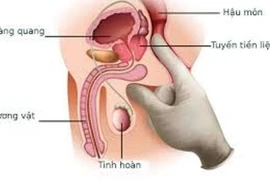 Tăng sản lành tính tuyến tiền liệt