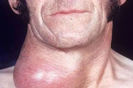 Điều trị basedow bằng thuốc