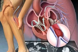 Thay đổi lối sống tránh tắc động mạch.