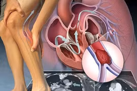 Thay đổi lối sống tránh tắc động mạch.