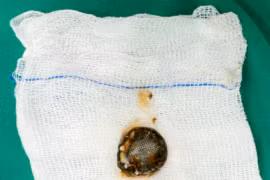 Nuốt pin cúc áo, bé trai bị bỏng hóa chất gây chít hẹp thực quản