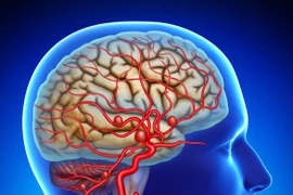 Điều trị túi phình động mạch não