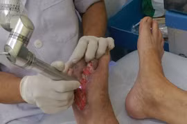 Khi nào phải chỉ định cắt cụt chi do đái tháo đường