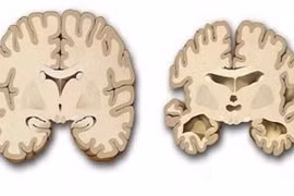 Báo động mối liên quan giữa béo phì và teo não