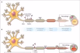 Viêm đa rễ và dây thần kinh ngoại biên