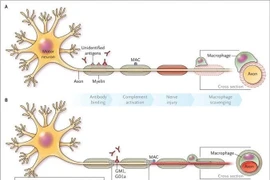 Viêm đa rễ và dây thần kinh ngoại biên