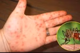 1 tuần ghi nhận 8000 ca mắc sốt xuất huyết