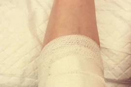 Gãy chân vì đi xe nghe nhạc