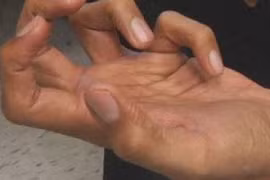 Rối loạn vận động co rút kiểu nhà văn