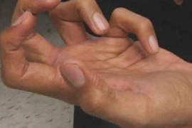 Rối loạn vận động co rút kiểu nhà văn