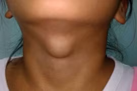 3 cách điều trị bướu giáp basedow