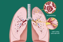 Fibrolysin – Hướng điều trị mới mang lại hiệu quả cao và an toàn cho các bệnh viêm đường hô hấp