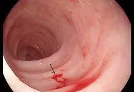 Những người hay bị chảy máu dạ dày 