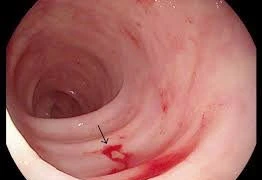 Những người hay bị chảy máu dạ dày 